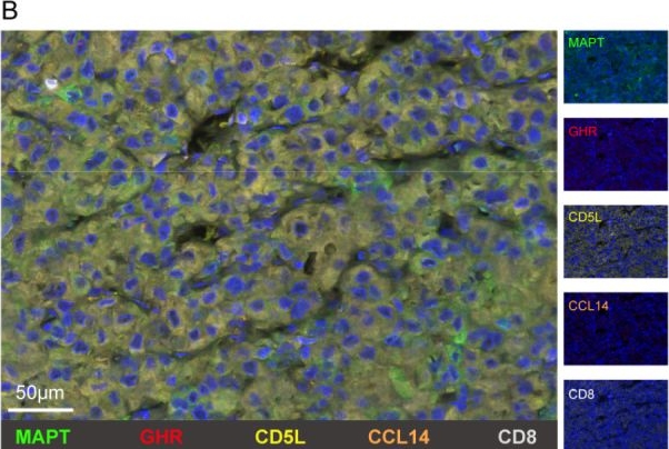 Fig.7.B showing Immunohistochemistry-immunofluorescence from the publication: Characterization and clinical verification of immune-related genes in hepatocellular carcinoma to aid prognosis evaluation and immunotherapy.