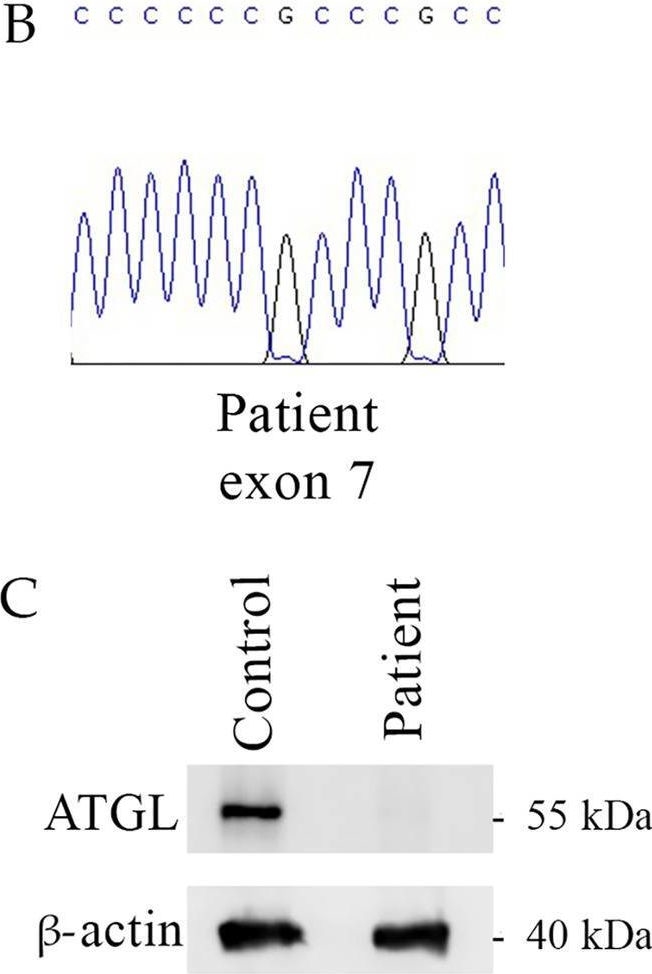 Fig.2.B showing Western Blotting in a Homo sapiens (Human) sample from the publication: Case Report: Pathogenic PNPLA2 variants and nonsense-mediated mRNA decay result in an early-onset neutral lipid storage disease with myopathy.
