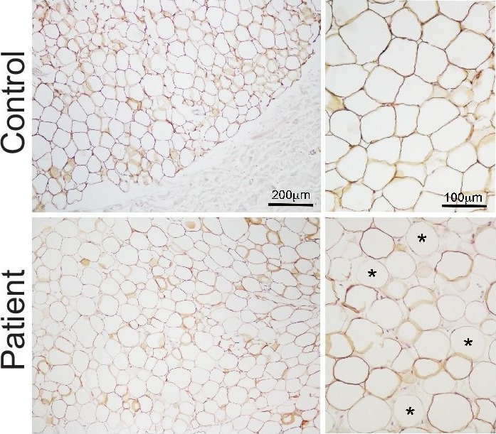 Human biallelic MFN2 mutations induce mitochondrial dysfunction, upper body adipose hyperplasia, and suppression of leptin expression.