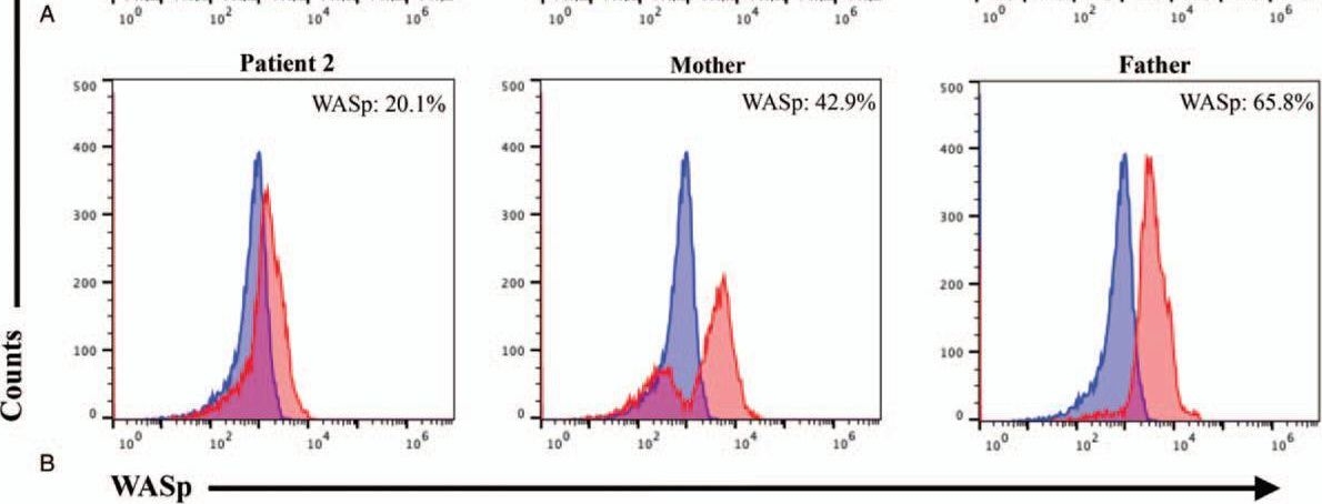 Fig.6.A showing Flow cytometry/Cell sorting in a Homo sapiens (Human) sample from the publication: Clinical and genetic analysis of 2 rare cases of Wiskott-Aldrich syndrome from Chinese minorities: Two case reports.