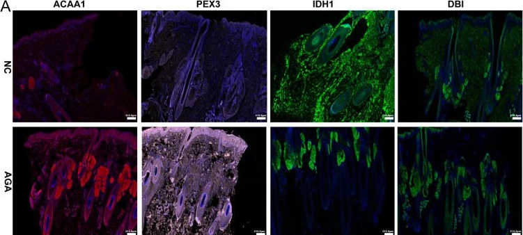 Fig.4.A showing Immunohistochemistry-immunofluorescence in a Homo sapiens (Human) sample from the publication: Integrated Multi-Omics Analysis Reveals Dysregulated Lipid Metabolism as a Novel Mechanism in Androgenetic Alopecia.