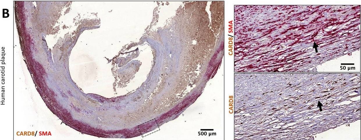 Fig.2.B showing Immunohistochemistry from the publication: Expression of CARD8 in human atherosclerosis and its regulation of inflammatory proteins in human endothelial cells.