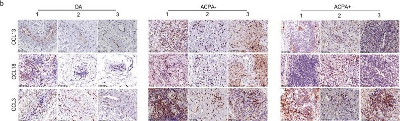 Fig.6.B showing Immunohistochemistry from the publication: Single-cell sequencing of immune cells from anticitrullinated peptide antibody positive and negative rheumatoid arthritis.