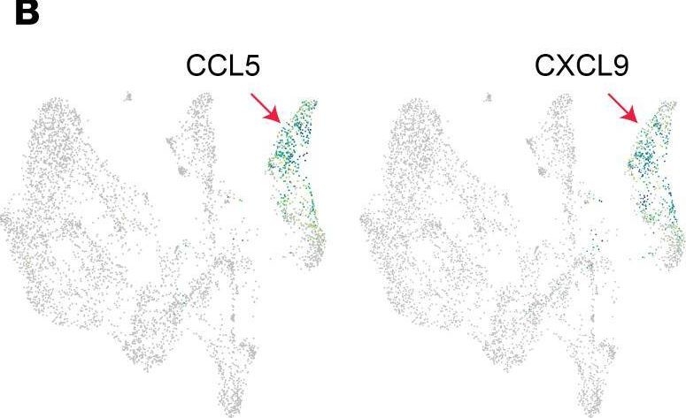 Fig.4.B showing Immunohistochemistry in a Homo sapiens (Human) sample from the publication: SPP1hi macrophages, NKG7 T cells, CCL5hi fibroblasts, and IgM plasma cells are dominant features of necrobiosis.