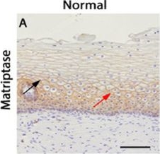 Fig.1.A showing Immunohistochemistry in a Homo sapiens (Human) sample from the publication: KLK5 and KLK7 drive cervical carcinoma via KLK14-dependent RhoA and NF-κB pathways.