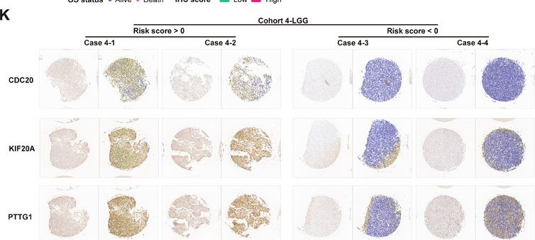 Fig.2.K showing Immunohistochemistry from the publication: The Hypoxia-Associated High-Risk Cell Subpopulation Distinctly Enhances the Progression of Glioma.