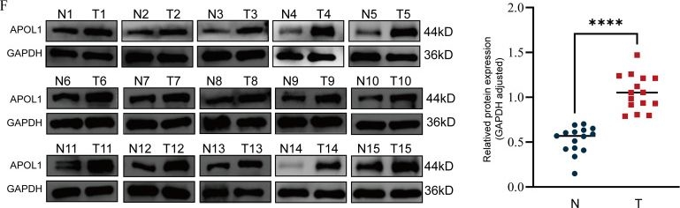 Fig.1.F showing Western Blotting from the publication: APOL1 is a novel prognostic biomarker in thyroid cancer and correlates with immune infiltration.