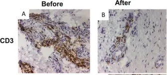 Fig.1.A,B showing Immunohistochemistry in a Homo sapiens (Human) sample from the publication: Synovial membrane immunohistology in early-untreated rheumatoid arthritis reveals high expression of catabolic bone markers that is modulated by methotrexate.