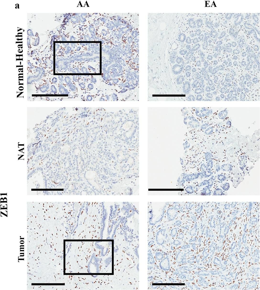 Fig.5.A showing Immunohistochemistry in a Homo sapiens (Human) sample from the publication: Stromal heterogeneity may explain increased incidence of metaplastic breast cancer in women of African descent.