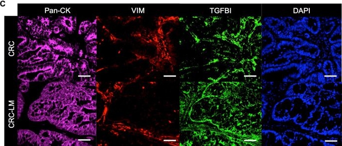 Fig.1.C showing Immunohistochemistry-immunofluorescence in a Homo sapiens (Human) sample from the publication: Metastatic colorectal cancer cells maintain the TGFβ program and use TGFBI to fuel angiogenesis.