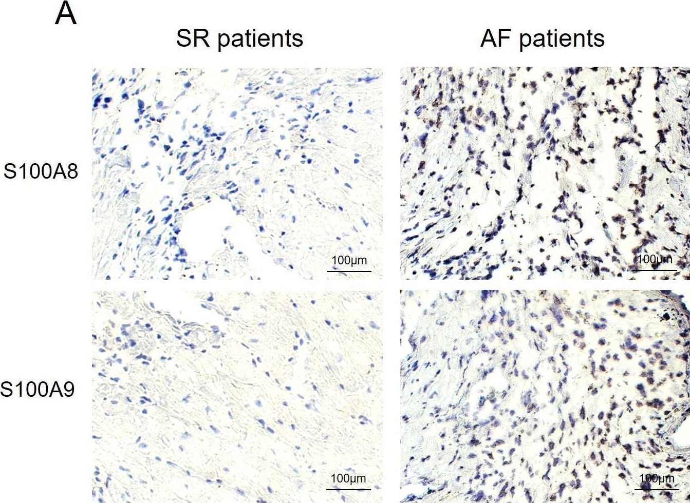 Fig.3.A showing Immunohistochemistry in a Homo sapiens (Human) sample from the publication: Myeloid-specific S100A8/A9 deficiency attenuates atrial fibrillation through prevention of TLR4/NF-kB-mediated immune cell recruitment and inflammation.