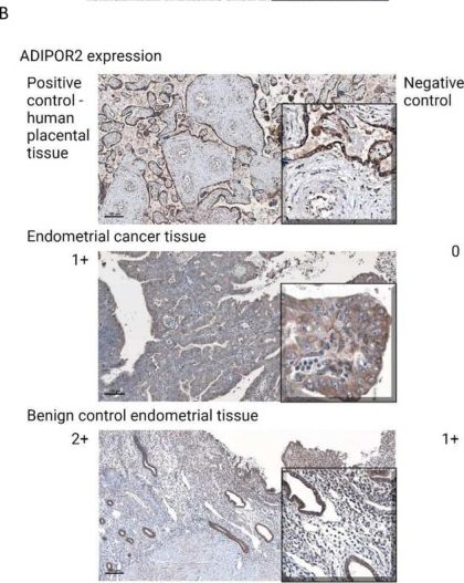 Fig.4.B showing Immunohistochemistry from the publication: Exploring the Relationship Between Adipocytokines and Endometrial Cancer: Identifying Correlations With Clinico-Pathological Prognostic Factors.