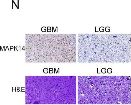 Fig.6.N showing Immunohistochemistry in a Homo sapiens (Human) sample from the publication: Targeting ARNT attenuates chemoresistance through destabilizing p38α-MAPK signaling in glioblastoma.