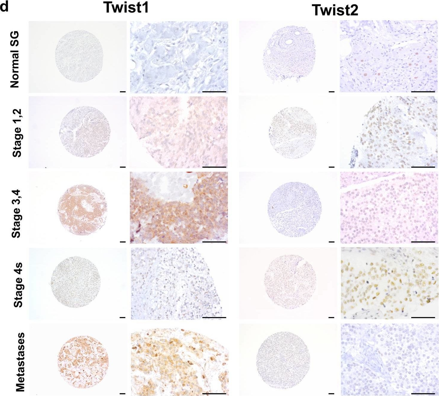 Fig.1.D showing Immunohistochemistry from the publication: TWIST1 expression is associated with high-risk neuroblastoma and promotes primary and metastatic tumor growth.