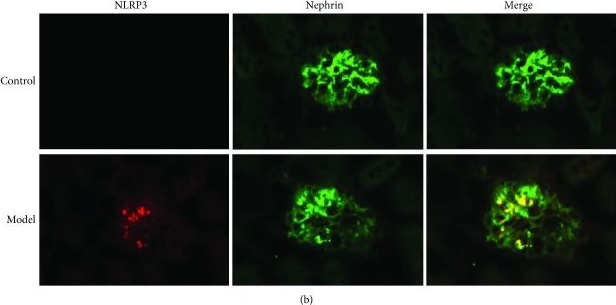 CD36-Mediated Lipid Accumulation and Activation of NLRP3 Inflammasome Lead to Podocyte Injury in Obesity-Related Glomerulopathy.