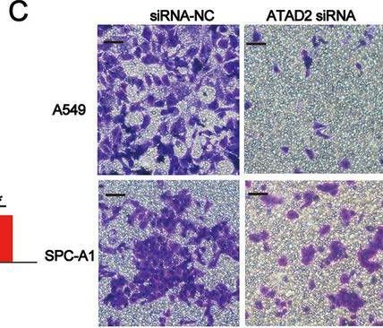 Fig.3.C showing Immunohistochemistry in a Homo sapiens (Human) sample from the publication: Effect of chronic intermittent hypoxia-induced HIF-1α/ATAD2 expression on lung cancer stemness.