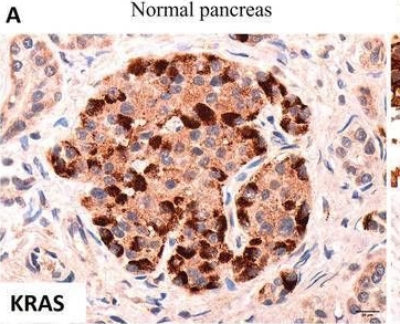 Fig.2.A showing Immunohistochemistry in a Homo sapiens (Human) sample from the publication: Analysis of Candidate miRNAs' Expression in Pancreatic Cancer.