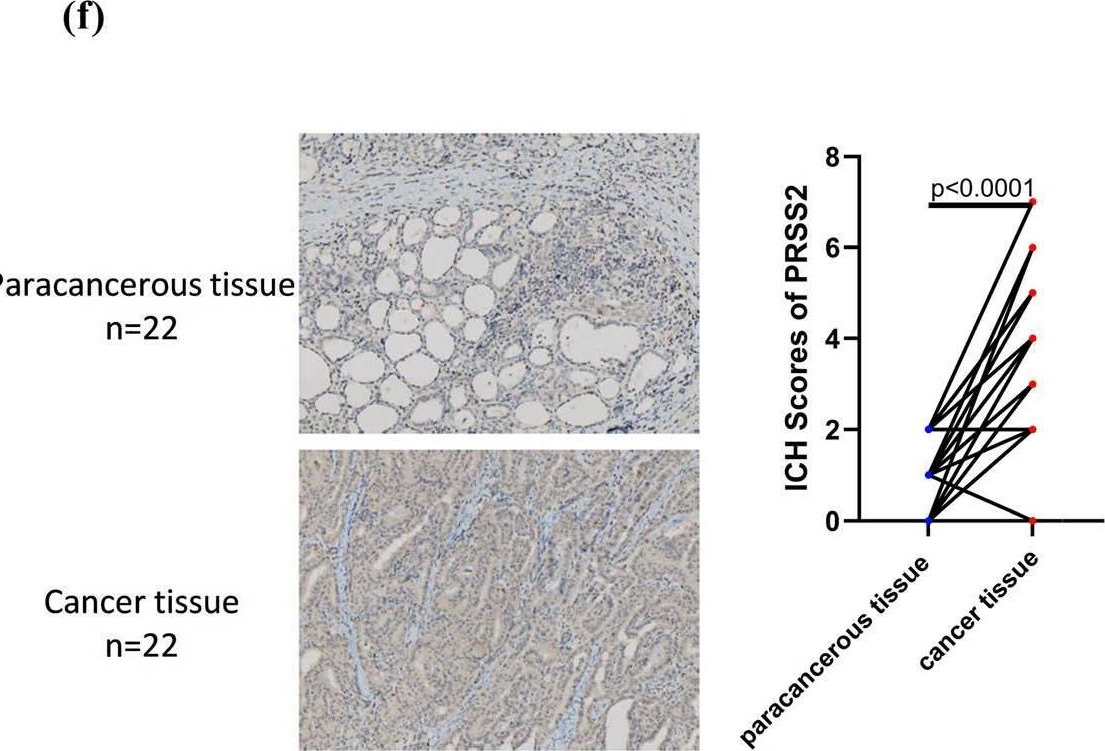 Fig.1.F showing Immunohistochemistry from the publication: Prognostic relevance of PRSS2 and its immune correlates in papillary thyroid carcinoma.