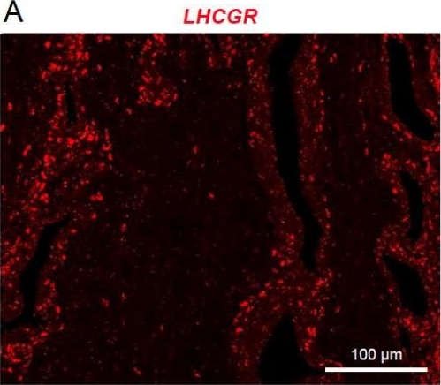 Fig.1.A showing Immunohistochemistry-paraffin in a Homo sapiens (Human) sample from the publication: Widespread Distribution of Luteinizing Hormone/Choriogonadotropin Receptor in Human Juvenile Angiofibroma: Implications for a Sex-Specific Nasal Tumor.