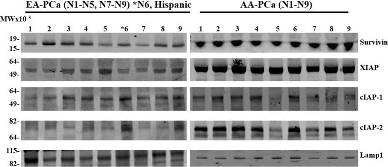 Fig.3.A showing Western Blotting in a Homo sapiens (Human) sample from the publication: Racial differences in the expression of inhibitors of apoptosis (IAP) proteins in extracellular vesicles (EV) from prostate cancer patients.