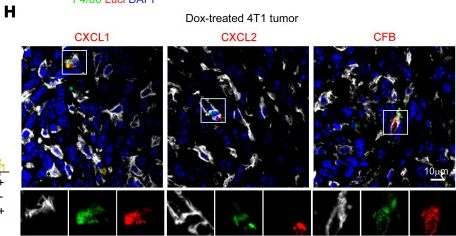 Fig.4.H showing Immunohistochemistry-immunofluorescence from the publication: Tumor-derived neutrophil extracellular trap-associated DNA impairs treatment efficacy in breast cancer via CCDC25-dependent epithelial-mesenchymal transition.