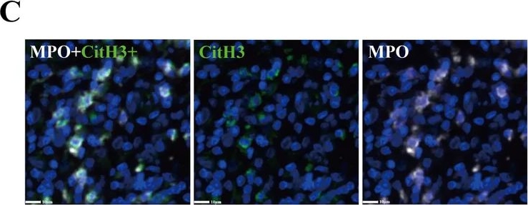 Fig.4.C showing Immunohistochemistry-immunofluorescence from the publication: The spatial landscape of the peritumoral interface: ARG1+ PMN-MDSCs reduction and NETosis as indicators of occult metastasis in tongue squamous cell carcinoma.