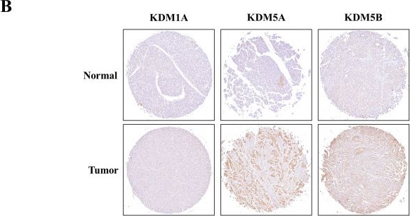 Fig.3.B showing Immunohistochemistry in a Homo sapiens (Human) sample from the publication: Multiple Comprehensive Analyses Identify Lysine Demethylase KDM as a Potential Therapeutic Target for Pancreatic Cancer.