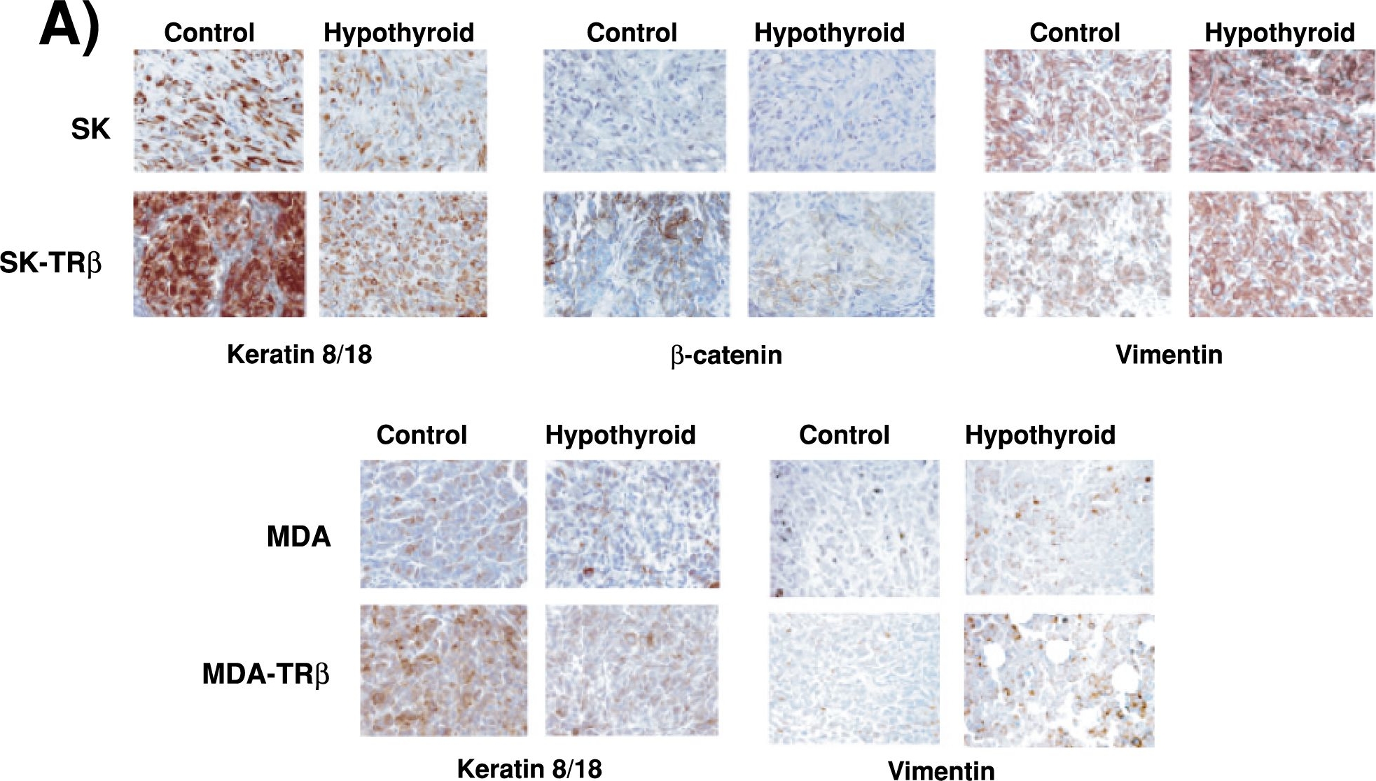Hypothyroidism enhances tumor invasiveness and metastasis development.