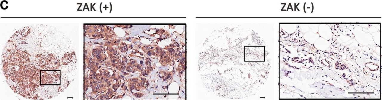 Fig.4.C showing Immunohistochemistry from the publication: Mixed lineage kinase ZAK promotes epithelial-mesenchymal transition in cancer progression.