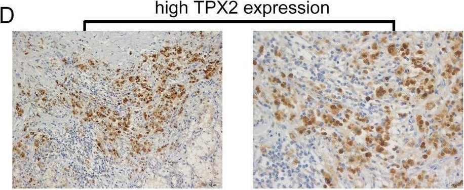 Fig.8.D showing Immunohistochemistry in a Homo sapiens (Human) sample from the publication: Identification of prognostic and therapeutic biomarkers in type 2 papillary renal cell carcinoma.