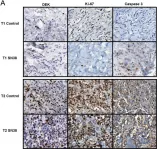 Fig.4.A showing Immunohistochemistry from the publication: DEK is a potential marker for aggressive phenotype and irinotecan-based therapy response in metastatic colorectal cancer.