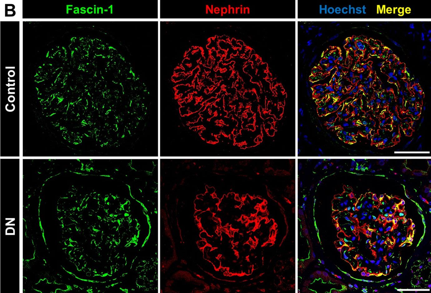 Studying the role of fascin-1 in mechanically stressed podocytes.