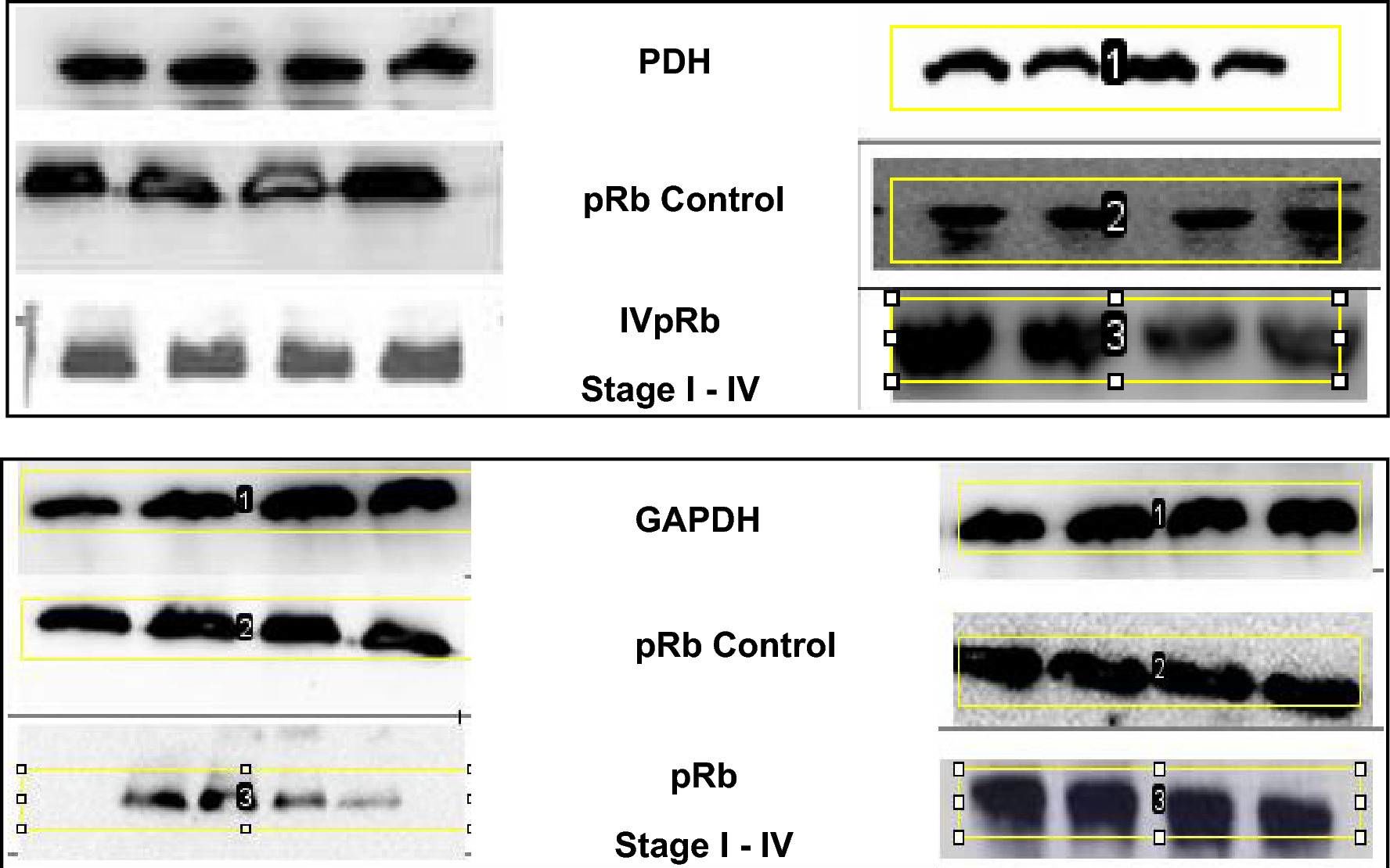 Fig.3.A showing Western Blotting in a Homo sapiens (Human) sample from the publication: Increased expression of HPV-E7 oncoprotein correlates with a reduced level of pRb proteins via high viral load in cervical cancer.