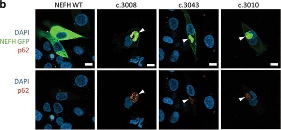 Cryptic amyloidogenic elements in mutant NEFH causing Charcot-Marie-Tooth 2 trigger aggresome formation and neuronal death.