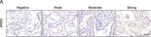 Fig.1.A showing Immunohistochemistry in a Mus musculus (House mouse) sample from the publication: Targeting HSPA1A in ARID2-deficient lung adenocarcinoma.
