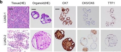 Fig.7.B showing Immunohistochemistry in a Homo sapiens (Human) sample from the publication: Transcriptomic analysis of tumor tissues and organoids reveals the crucial genes regulating the proliferation of lung adenocarcinoma.