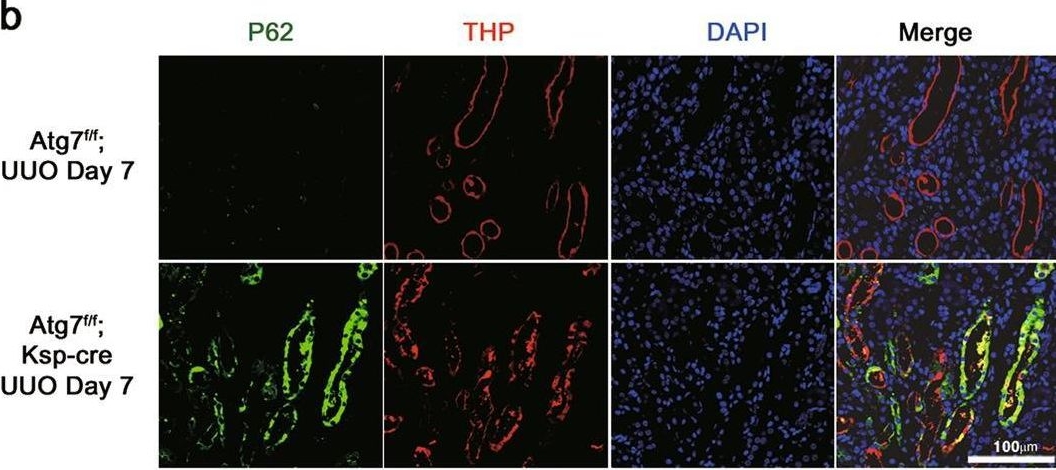 Autophagy attenuates tubulointerstital fibrosis through regulating transforming growth factor-β and NLRP3 inflammasome signaling pathway.