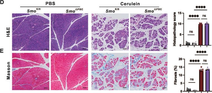 Fig.3.D showing Immunohistochemistry from the publication: TGF-β1/SMAD3-mediated Non-canonical Hedgehog Signaling Promotes Pancreatic Stellate Cell Activation and Fibrosis in Chronic Pancreatitis.