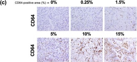 Fig.4.C showing Immunohistochemistry in a Homo sapiens (Human) sample from the publication: The contribution of the CRP/CD64 axis to renal cancer progression by inducing protumor activation of tumor-associated macrophages.