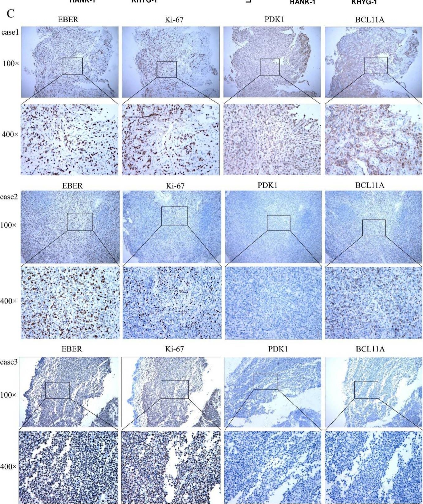 Fig.6.C showing Immunohistochemistry from the publication: CircKIF4A Is a Prognostic Factor and Modulator of Natural Killer/T-Cell Lymphoma Progression.