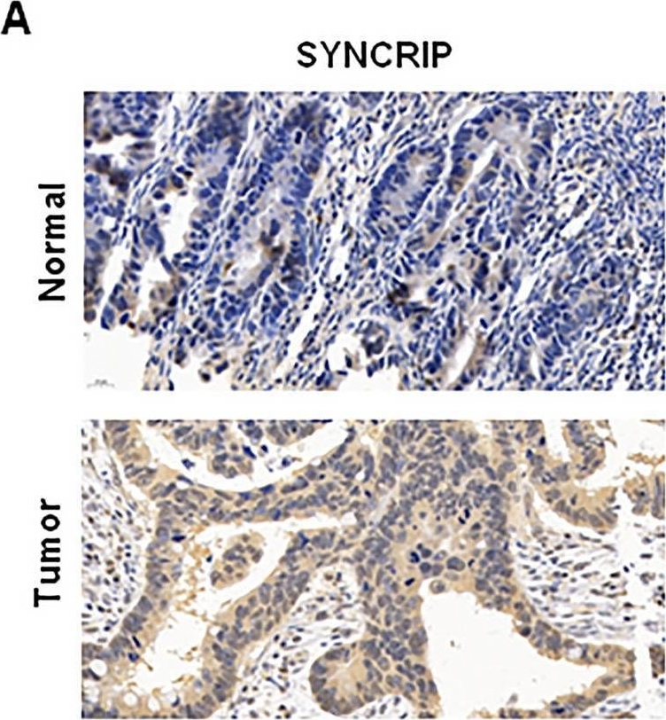 Fig.2.A showing Immunohistochemistry in a Homo sapiens (Human) sample from the publication: The up-regulation of SYNCRIP promotes the proliferation and tumorigenesis via DNMT3A/p16 in colorectal cancer.