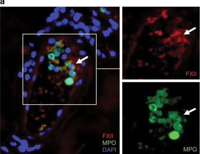 Fig.4.A showing Immunocytochemistry-immunofluorescence from the publication: Cold-induced urticarial autoinflammatory syndrome related to factor XII activation.