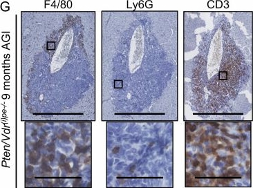 Fig.4.G showing Immunohistochemistry in a Homo sapiens (Human) sample from the publication: Impaired vitamin D signaling reveals neutrophils as key drivers of prostate cancer dissemination.