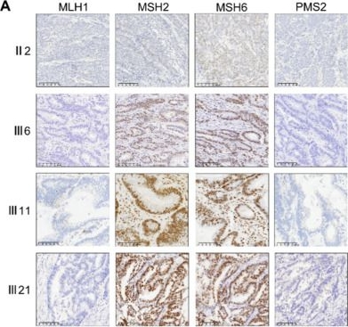Fig.2.A showing Immunohistochemistry in a Homo sapiens (Human) sample from the publication: Integrative proteomics reveals mitochondrial and immune signatures of MLH1 exon 13 deletion in Lynch syndrome-associated colorectal cancer.