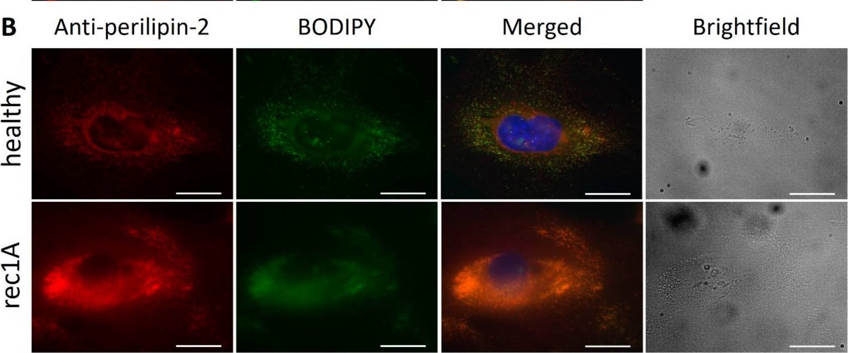 Primary Focal Segmental Glomerulosclerosis Plasmas Increase Lipid Droplet Formation and Perilipin-2 Expression in Human Podocytes.