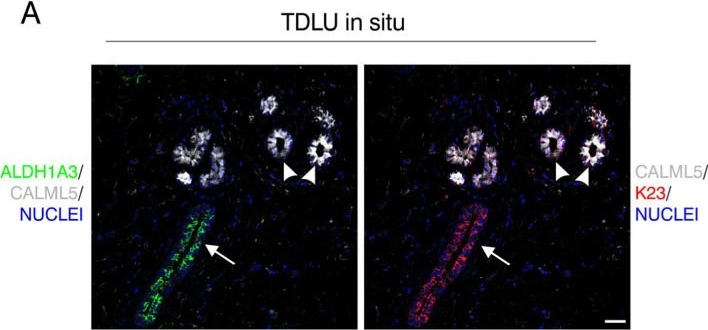 Fig.4.A showing Immunohistochemistry-immunofluorescence from the publication: Oncogene activated human breast luminal progenitors contribute basally located myoepithelial cells.