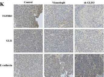 Fig.7.K showing Immunohistochemistry in a Homo sapiens (Human) sample from the publication: GLIS3 drives epithelial-mesenchymal transition and cancer stem-like traits in stomach adenocarcinoma via TGFBR3-Hedgehog signaling.