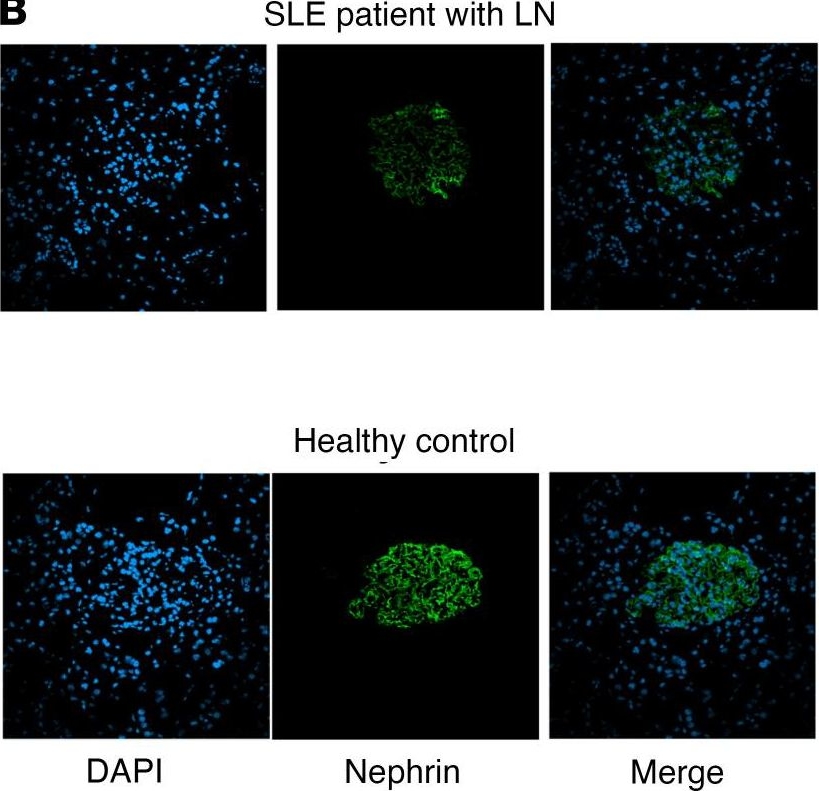 Aberrantly glycosylated IgG elicits pathogenic signaling in podocytes and signifies lupus nephritis.