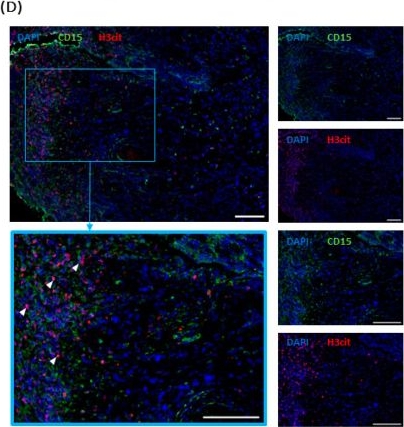 Fig.3.D showing Immunohistochemistry-immunofluorescence in a Homo sapiens (Human) sample from the publication: Evidence of Neutrophils and Neutrophil Extracellular Traps in Human NMSC with Regard to Clinical Risk Factors, Ulceration and CD8+ T Cell Infiltrate.