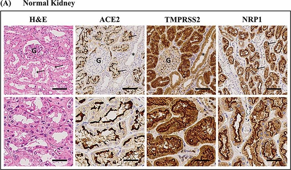 Fig.2.A showing Immunohistochemistry from the publication: SARS-CoV-2 replicates and displays oncolytic properties in clear cell and papillary renal cell carcinoma.